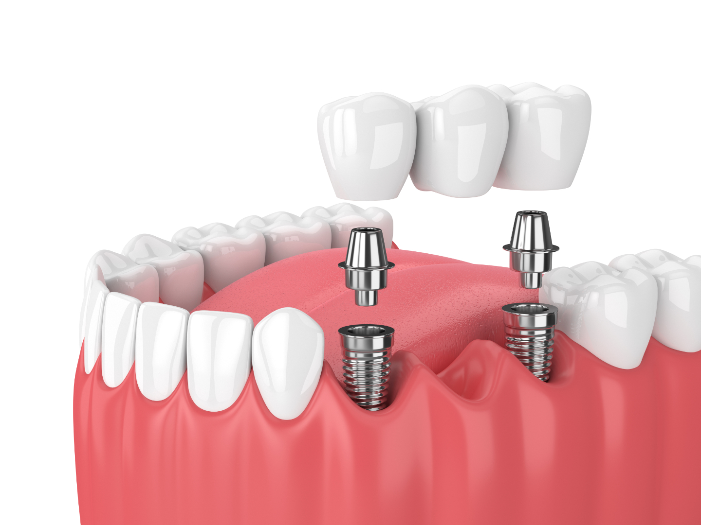 visit Colina Dental's website here