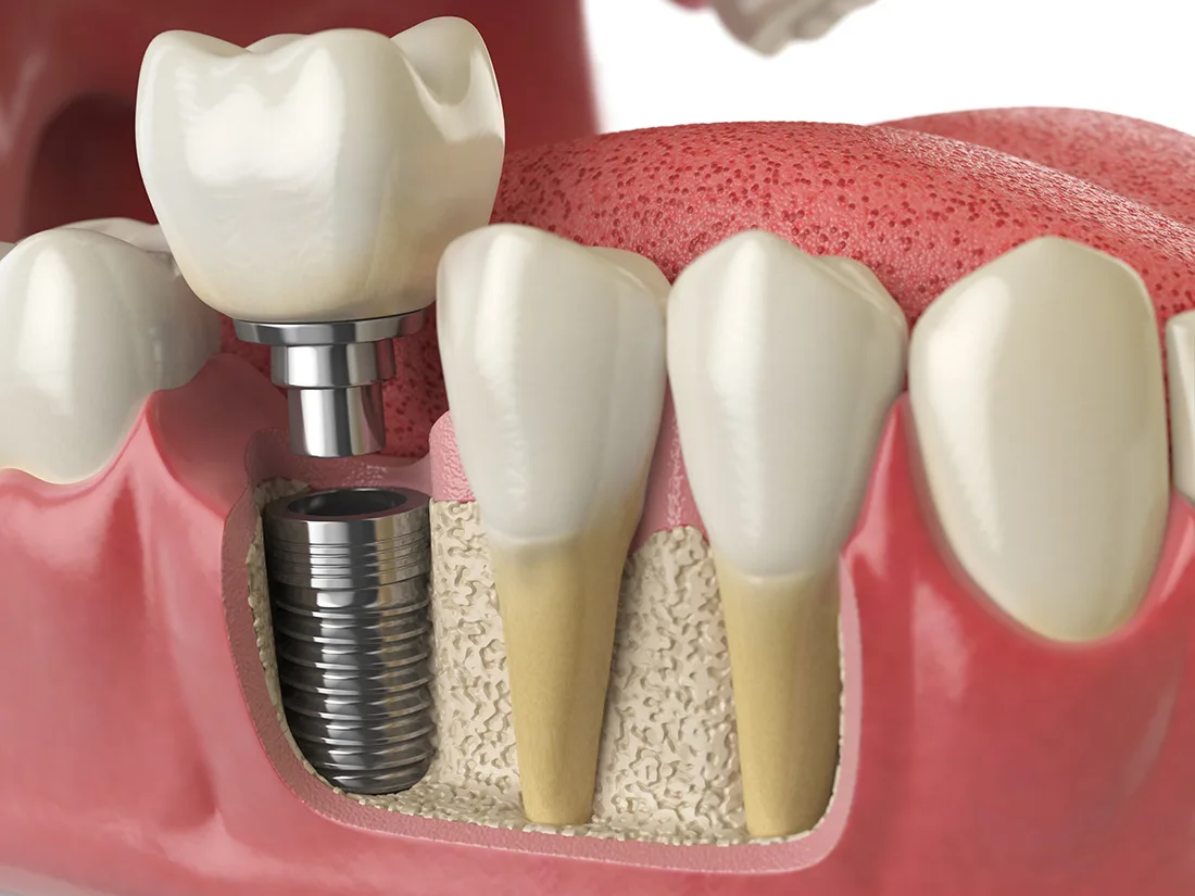 The Importance of Periodontal Care in Everyday Dental Health